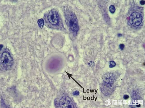 拳王阿里之死:揭秘帕金森症